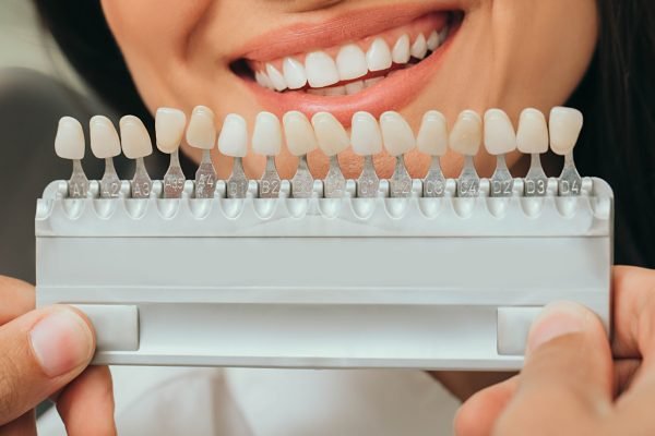 teeth palette with different shades of teeth near female smiling. Stomatology, whitening teeth, tooth implant